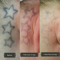 دستگاه آلمانی ۲۰۲۴ لیزرموهای زائد adss|خدمات آرایشگری و زیبایی|تربت جام, المهدی|دیوار