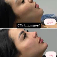 فیلر مزوتراپی لیزر بوتاکس