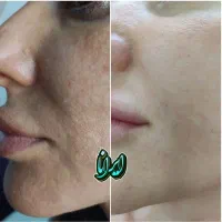 سفیدکردن بیکینی،زیربغل،صورت (کلینیک ایرانا)|خدمات آرایشگری و زیبایی|یاسوج, |دیوار