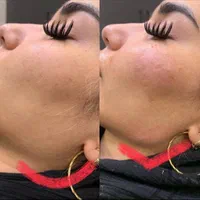 تزریق بوتاکس اصلی، ژل لب، خط خنده، زاویه فک وچانه|خدمات آرایشگری و زیبایی|ورامین, ورامین|دیوار
