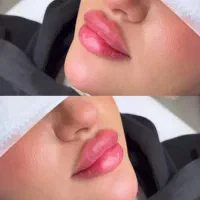 ژل وبوتاکس.افزایش سایزآلت آقا.لیفت بانخ توسط پزشک