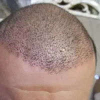 آفر ویژه کاشت مو و ابرو|خدمات آرایشگری و زیبایی|تهران, دبستان|دیوار