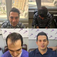 کلینیک کاشت مو