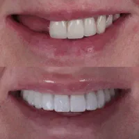 ایمپلنت دندان بدون جراحی
