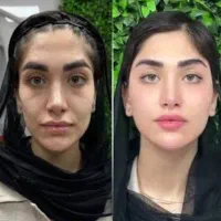 جشنواره تخفیف ژل وبوتاکس پی آرپی مزو/مادلینگ|خدمات زیبایی و سلامت|تبریز, |دیوار