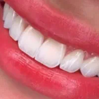 دندان مصنوعی،دندان،دندانسازی،پنجاه درصدتخفیف ویژه|خدمات زیبایی و سلامت|مشهد, پایین خیابان|دیوار