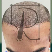 کاشت مو و ابرو vip و تضمینی