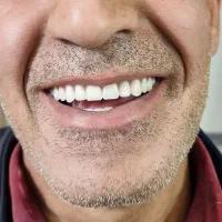 دندان مصنوعی(دست دندان )|خدمات آرایشگری و زیبایی|مرند, |دیوار