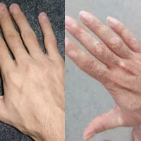 درمان دائمی بیماری پوستی خود ایمنی|خدمات آرایشگری و زیبایی|کوهنجان, |دیوار