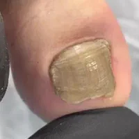 بیماری های ناخن تیرگی قوزک پدیکور آقایان و خانم ها|خدمات آرایشگری و زیبایی|زنجان, |دیوار