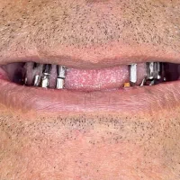 ایمپلنت ایرانی ۱۶۵۰۰ اقساط ویژه