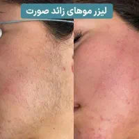 لیزر موژان|خدمات آرایشگری و زیبایی|تهران, اتابک|دیوار