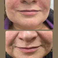 تزریق ژل و بوتاکس و پی ارپی و مزوتراپی و لیزر مو|خدمات آرایشگری و زیبایی|بوشهر, |دیوار