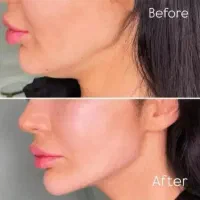 پی آرپیprp بایوفیلر اگزوزوم ژل بوتاکس آنزیم اقساط|خدمات زیبایی و سلامت|کرج, گوهردشت|دیوار