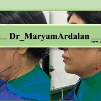 ساکشن غبغب بوکال فت و کانتورینگ دایم صورت