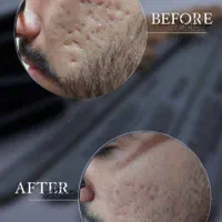 ژل بوتاکس مزوتراپی prp با قیمت استثنائی توسط پزشک|خدمات آرایشگری و زیبایی|اسلام‌شهر, باغ فیض|دیوار