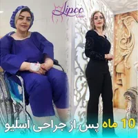 جراحی عمل اسلیومعده/اسلیو معده/چاقی لاغری/اسلیو|خدمات آرایشگری و زیبایی|تهران, چیتگر جنوبی|دیوار