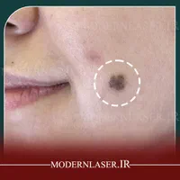 درمان کامل انواع خال و زائده های پوستی بدون بازگشت|خدمات آرایشگری و زیبایی|اصفهان, سعادت‌آباد|دیوار