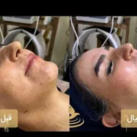 فیشال(پاکسازی) اقتصادی صورت vip|خدمات آرایشگری و زیبایی|محمدیه-قزوین, |دیوار