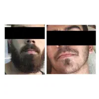 معجزه ریش