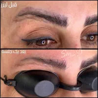 ریموو تخصصی تتوی ابرو، چشم، لب