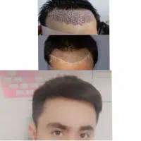 کاشت تخصصی مو وابرو