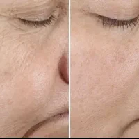 جوانسازی پوست با روش بیوممتیک