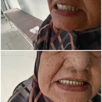 دندانسازی مصنوعی حرفه ای برای همه لبخندها|خدمات آرایشگری و زیبایی|مشهد, کوی سیدی|دیوار