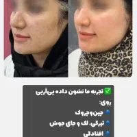تزریقات زیبایی وجوانسازوفیلرها باتخفیف ویژه|خدمات آرایشگری و زیبایی|دوگنبدان, |دیوار