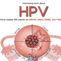 راهنمایی زگیل تناسلی hpv
