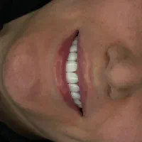 کامپوزیت دندان|خدمات آرایشگری و زیبایی|تهران, سلسبیل شمالی|دیوار