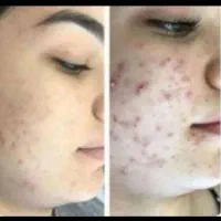 کرم سفید کننده ضدلک وضدجوش اصل سورو|آرایشی، بهداشتی، درمانی|بندرعباس, |دیوار