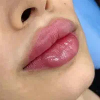 خدمات زیبای فیلر و بوتاکس