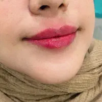 فیلر و بوتاکس نوروزی کلینیک بهتا