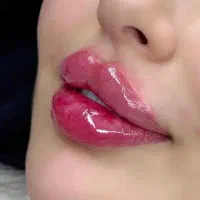 تزریق فیلر،بوتاکس،مزو تراپی.پی ار پی،کربن تراپی