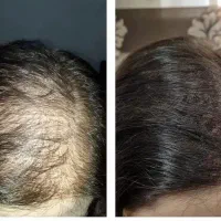 جشنواره لیفت شقیقه و ابدومینوپلاستی مرکز جراحی الی|خدمات زیبایی و سلامت|تهران, بهجتآباد|دیوار