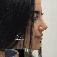 مشاوره تخصصی و رایگان عمل بینی