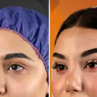 آف۲۰روز/۴۰٪لیفت شقیقه وجراح پلاستیک بدن/دستگاه پال|خدمات آرایشگری و زیبایی|مشهد, کوه سنگی|دیوار