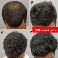 هایفو7 بعدی کل صورت999 هزارتومن|خدمات آرایشگری و زیبایی|اهواز, نادری|دیوار