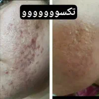 درمان مشکلات بدنی|آرایشی، بهداشتی، درمانی|سیرجان, |دیوار