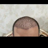 کاشت مو تخصصی مرضیه محمودی|خدمات آرایشگری و زیبایی|شیراز, زرگری|دیوار