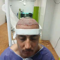 کشت مو ب روش fit|خدمات آرایشگری و زیبایی|کرمان, |دیوار