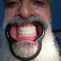 کاشت ایمپلنت یا کمترین درد متخصص فک صورت|خدمات آرایشگری و زیبایی|تهران, توحید|دیوار