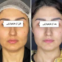 جوانسازی و لیفت پوست بدون جراحی با قویترین هایفو|خدمات آرایشگری و زیبایی|کرج, فاز ۲ مهرشهر|دیوار