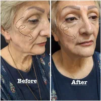 هایفو صورت و واژینال