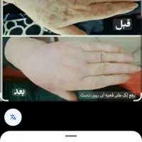 الکترولیز موی سفید و خال بردای|آرایشی، بهداشتی، درمانی|یاسوج, |دیوار