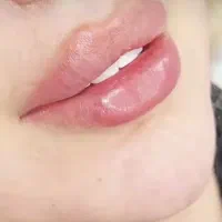 نیاز به مدل برای تزریق ژل و بوتاکس