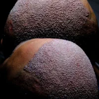 کاشت مو ، اَبرو ، تحت نظر متخصص پوست کلینیک تابان