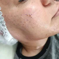 فیلر/ژل/بوتاکس ،بدون درد و کبودی|خدمات آرایشگری و زیبایی|شیراز, مسلم|دیوار