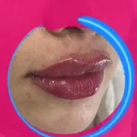 تزریق ژل و بوتاکس|خدمات آرایشگری و زیبایی|قم, صدوق|دیوار